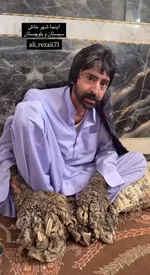 فیلمی ناراحتکننده از بیماری عجیب مرد درختی در سیستان و بلوچستان