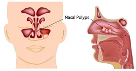 هزینه عمل پولیپ بینی (بیمارستان دولتی و خصوصی)