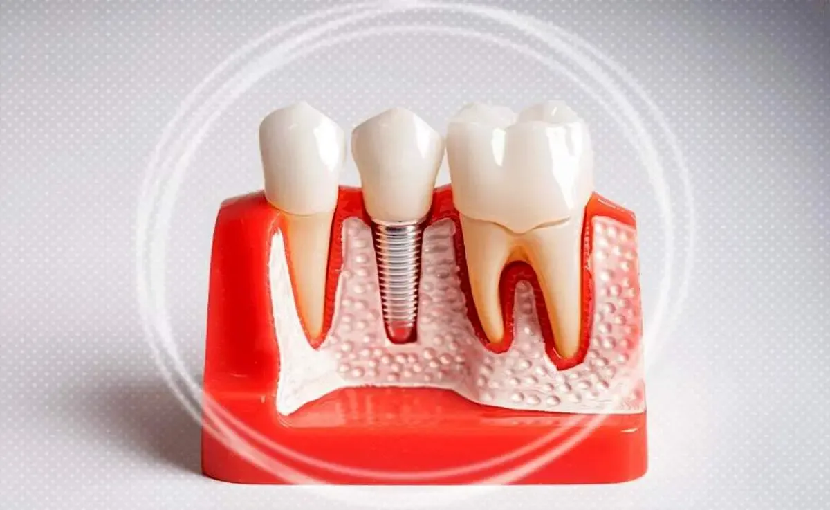 قیمت ایمپلنت کره ای