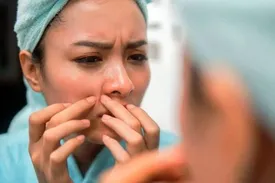 آکنه بزرگسالان/ چرا جوشها همچنان شما را آزار میدهند و چگونه درمانشان کنیم؟