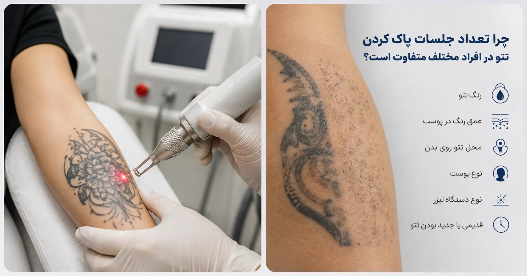 تعداد جلسات لیزر برای پاک کردن تتو