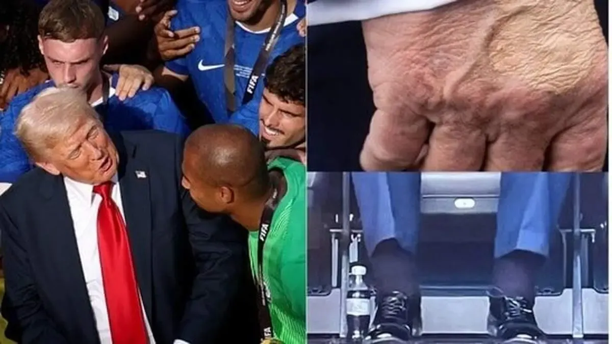 کبودی روی دست‌های ترامپ نشانه چیست؟