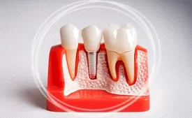 قیمت ایمپلنت کره ای