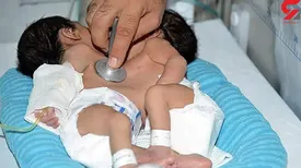 جداسازی خواهران دو قلو در بیمارستان نمازی شیراز + جزییات