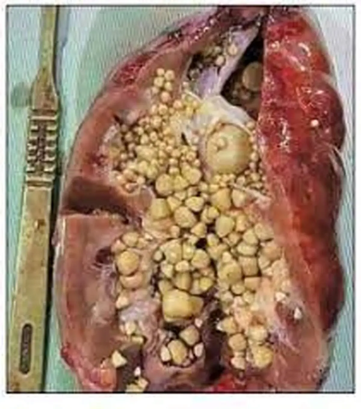 برای جلوگیری از تشکیل سنگ در کلیه چه کار کنیم؟