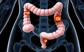 علائم این سرطان خاموش را بشناسید