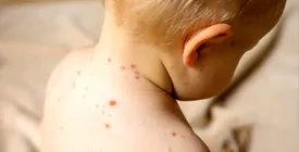 هشدار جدی درباره شیوع یک بیماری ویروسی در کودکان