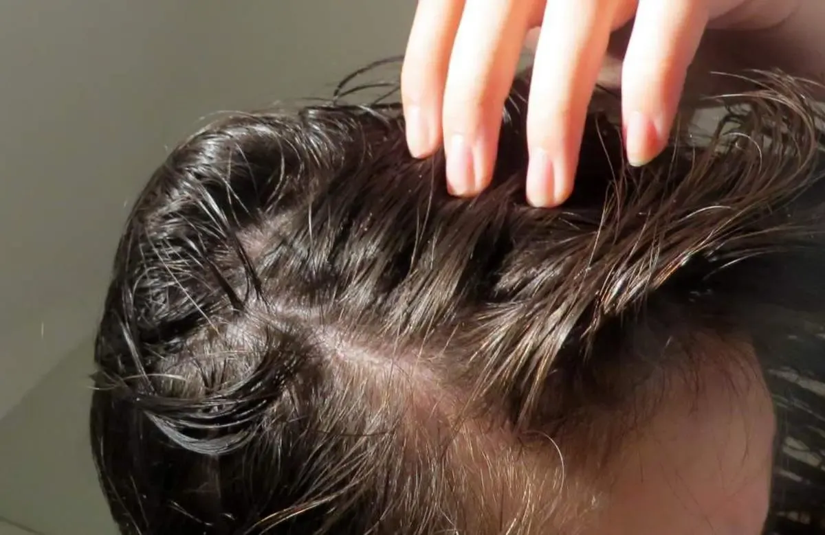 کمبود کدام ویتامین باعث ریزش مو می شود؟