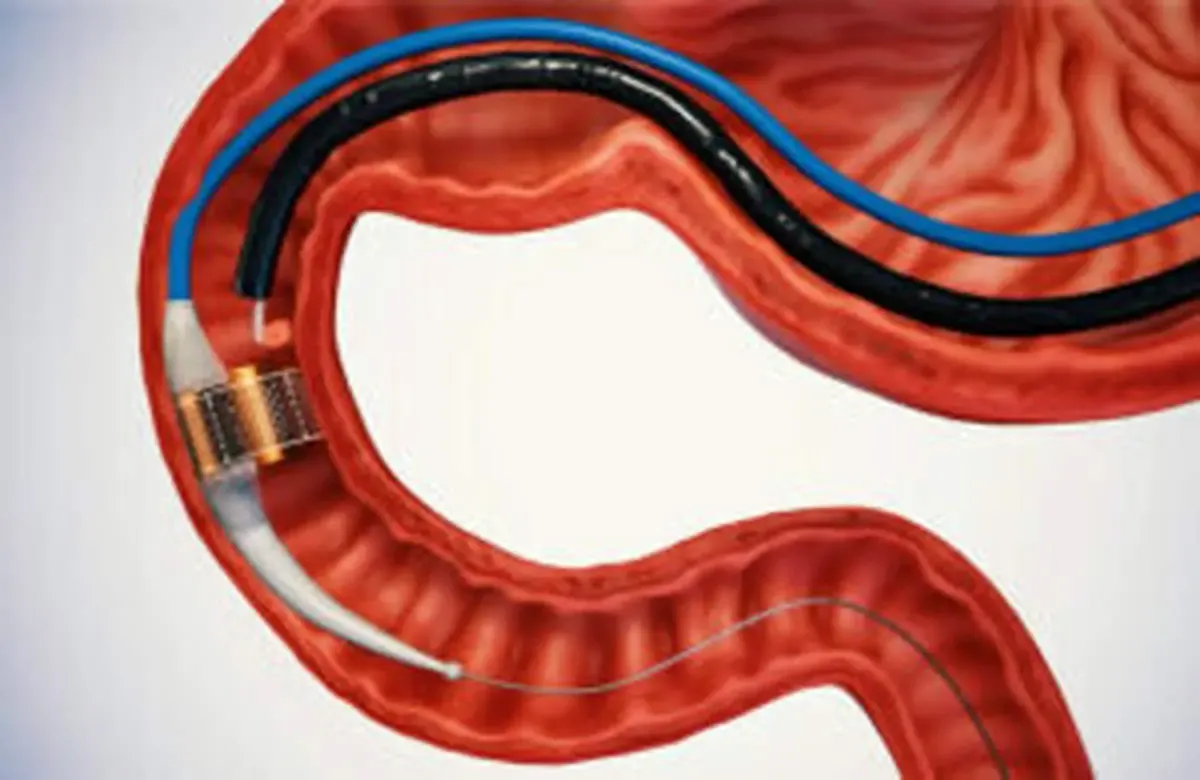 یک روش جدید برای درمان دیابت