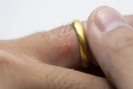 اگر شما هم پوست حساسی به فلزات دارید، بخوانید