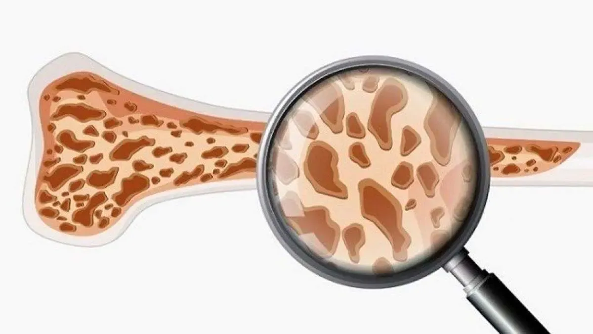 هشدار درباره یک نوع اختلال اسکلتی که جانتان را به خطر می‌اندازد