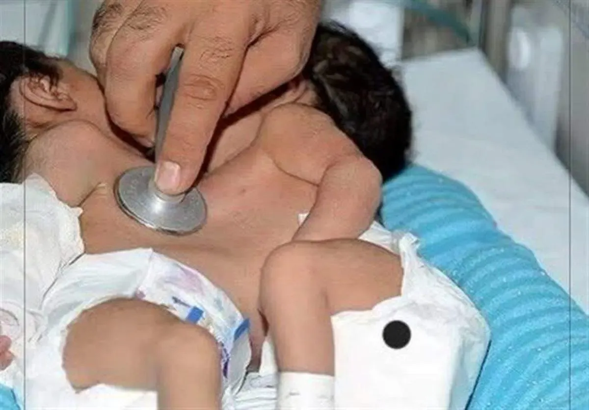 تلاش برای جداکردن دوقلوهای به‌هم‌چسبیده