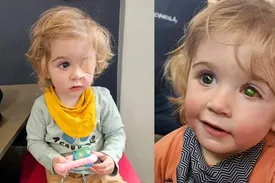 این کودک چشمش را بر اثر بوسیدن از دست داد/ عکس