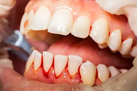 خونریزی لثه‌ها نشانه یک مشکل بزرگ‌ و جدی است؟