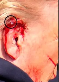 جراحت ترامپ ناشی از ترور نافرجام/عکس