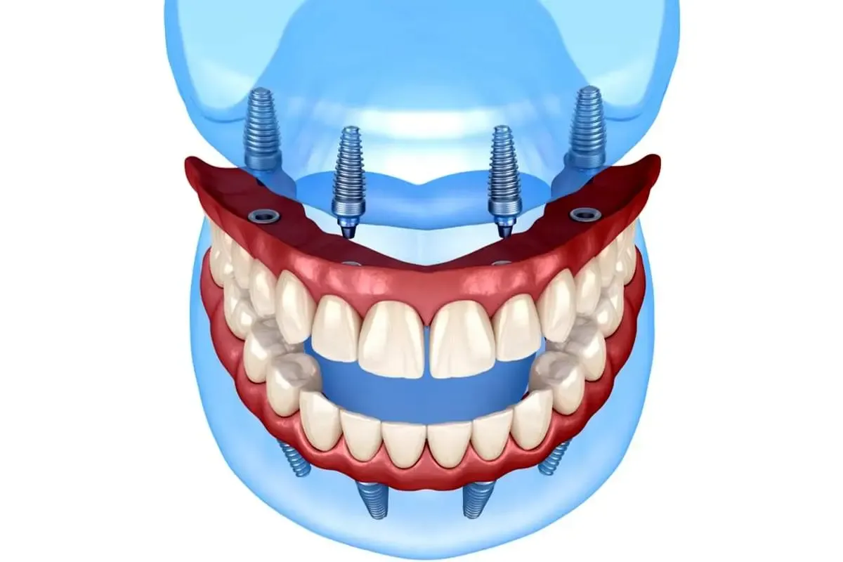 هزینه  ایمپلنت فول موس (فک بالا و پایین)