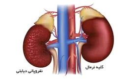 نارسایی کلیه چه علائم و عوارضی می تواند به همراه داشته باشد؟