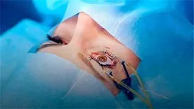 آیا جراحی چشم شامل بیمه تکمیلی میشود؟