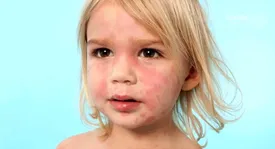 ببینید | غذاهای آلرژی‌زا برای کودکان که باید بشناسید