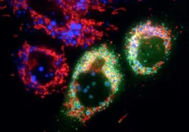 درمان سرطان با ذره بین