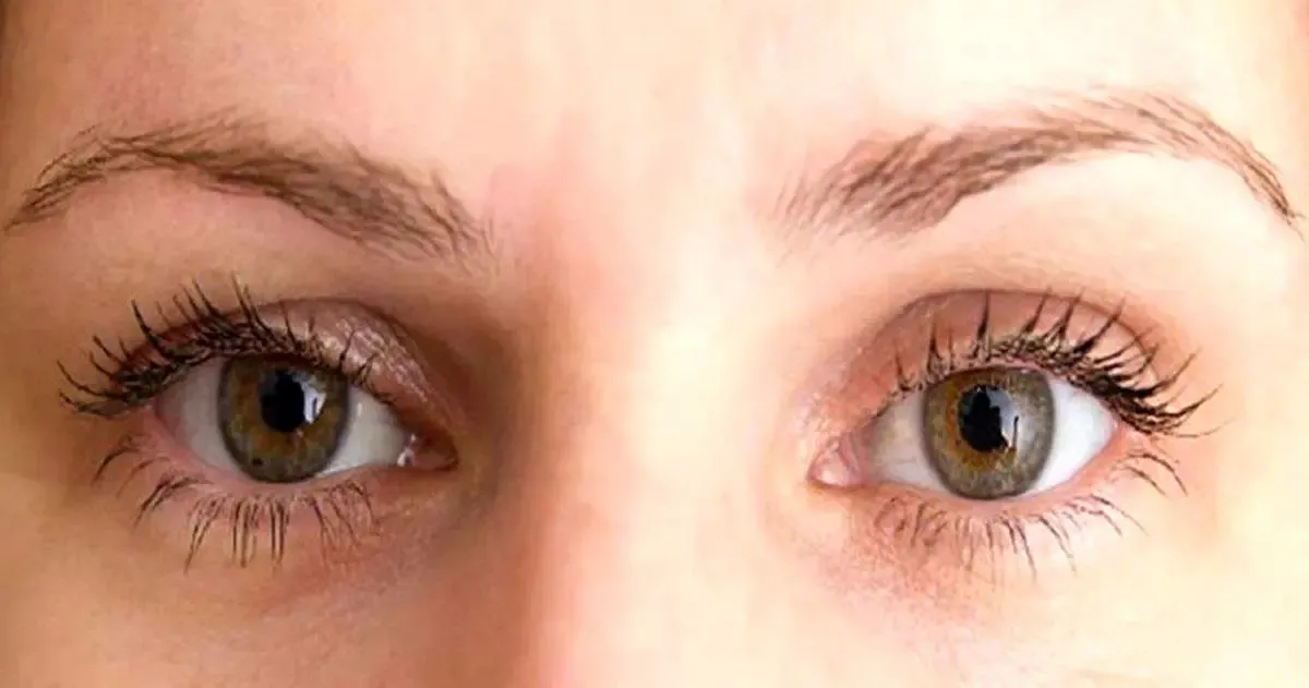 علل افتادگی پلک چشم