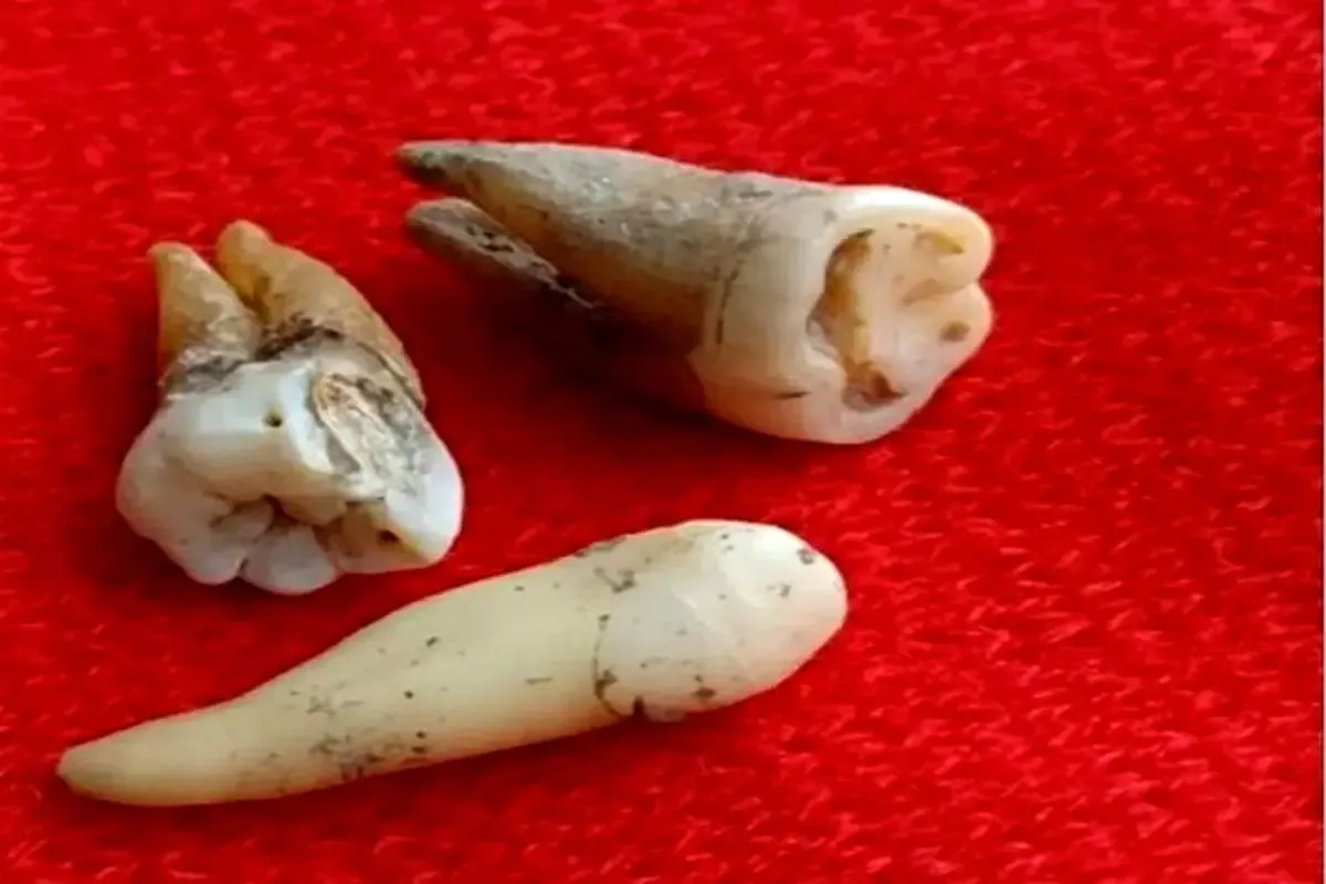 بهترین راه جلوگیری از پوسیدگی دندان چیست؟