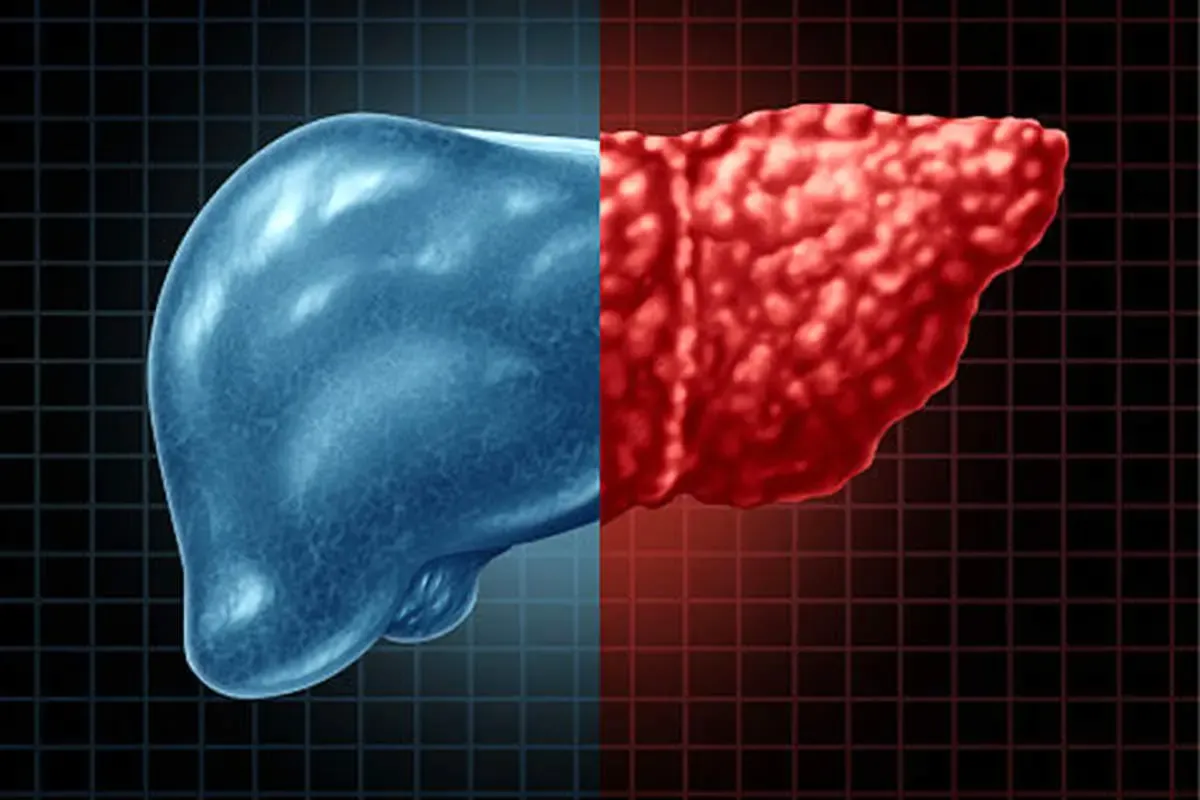 با این علائم شما کبد چرب دارید!