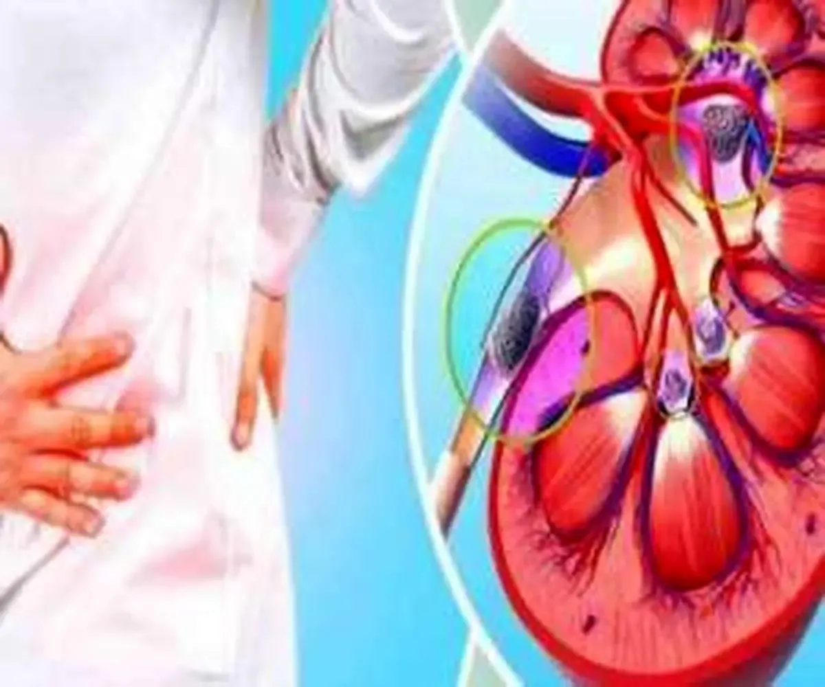 اینگونه بر سنگ کلیه غلبه کنید