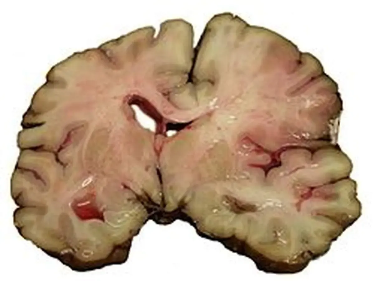 آیا میدانید ۹۰ درصد سکته‌های مغزی قابل پیشگیری هستند؟