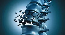 پوکی استخوان به‌دلیل کمبود این ویتامین