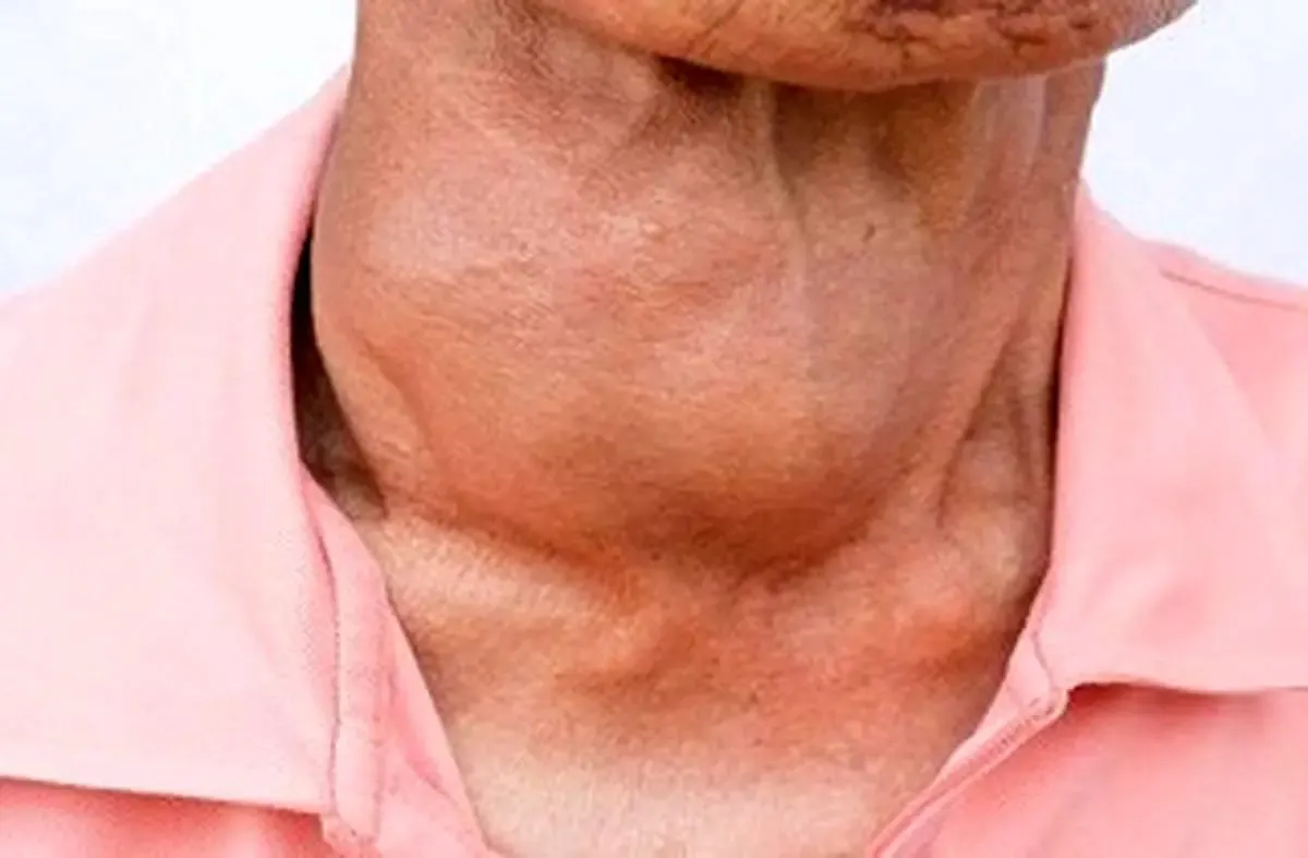 چطور تیروئید کم کار را کنترل کنیم؟