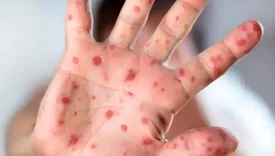 این بیماری ۲۹ نفر را در بابل روانه بیمارستان کرد