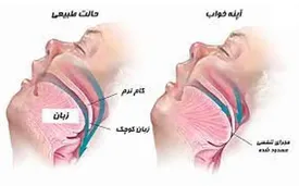 آپنه خواب یک تهدید جدی برای زندگی است