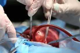 سرنوشت اولین پیوند ریه در ایران