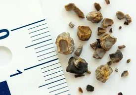 خارج کردن سنگ مثانه به وزن ۳.۱ کیلوگرم از بدن بیمار+ فیلم