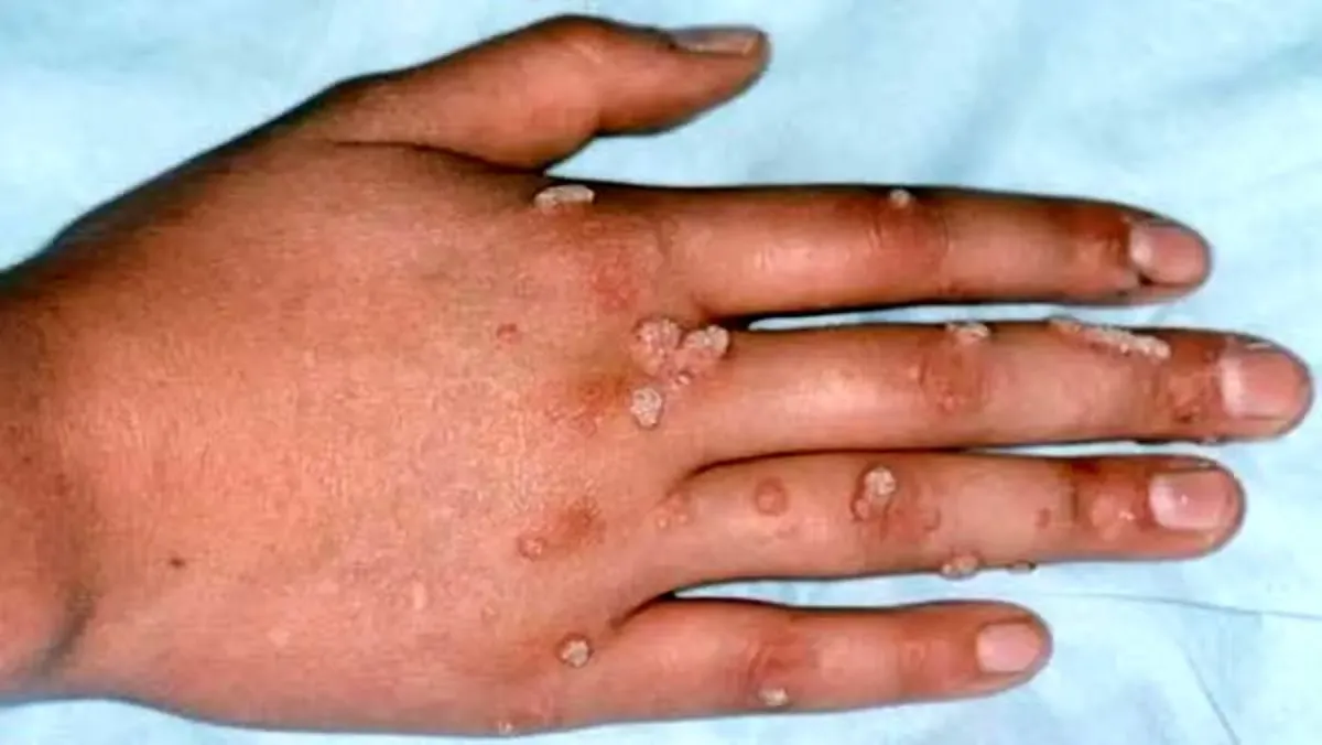 سرایت این بیماری خطرناک به آرایشگاه‌های زنانه؛ خانم های جوان مراقب باشند!