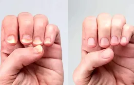 آیا سفیدی ناخن‌ها نشانه کم‌خونی است