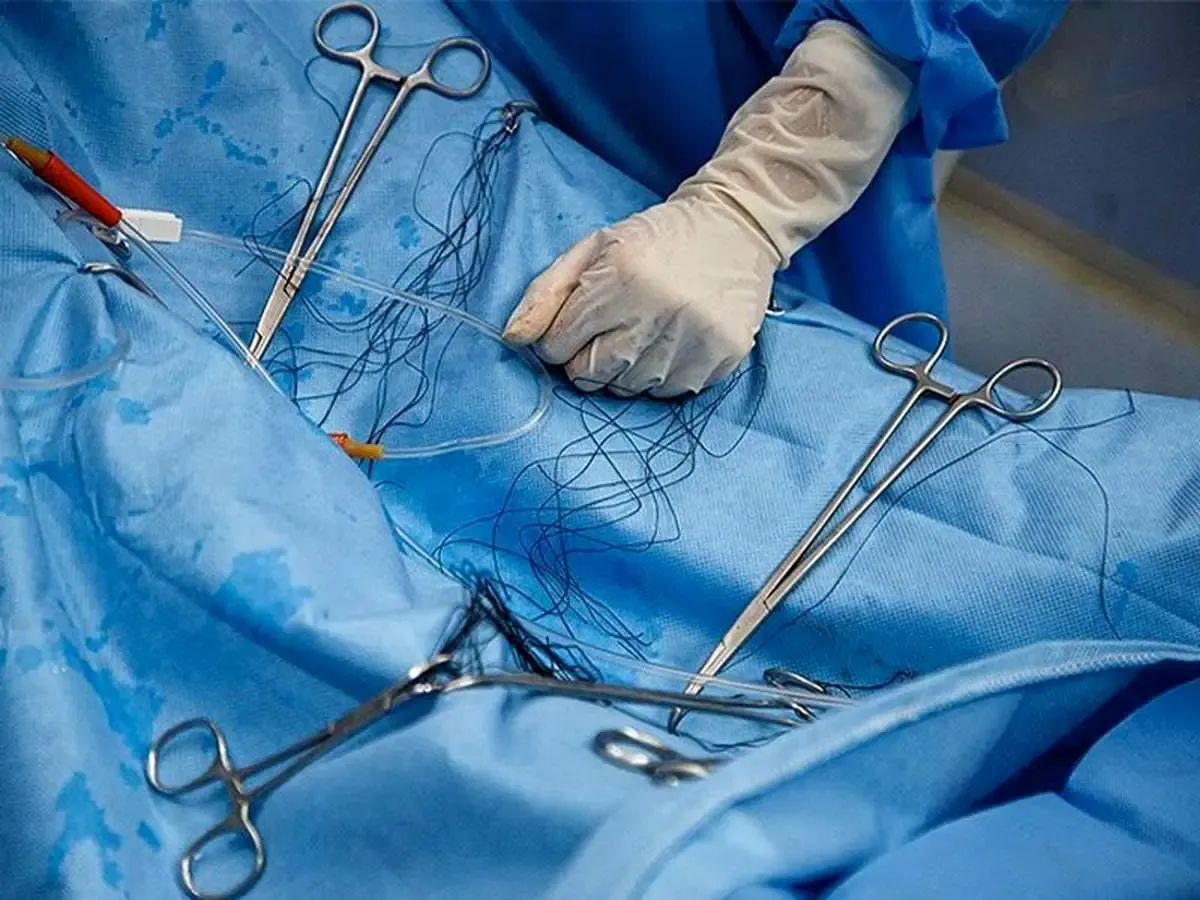 بزرگترین عمل چشم کامل جهان در آمریکا