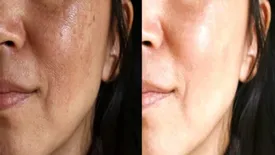 با این ۱۰ میوه پوستتان را به طور طبیعی بوتاکس کنید