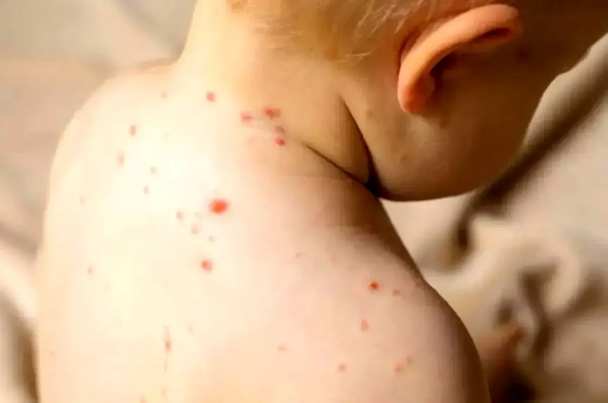 هشدار جدی درباره آمار فاجعه‌بار سرخک در ایران