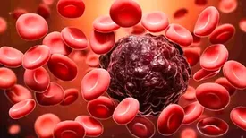 علایم اولیه سرطان خون که باید جدی گرفته شود