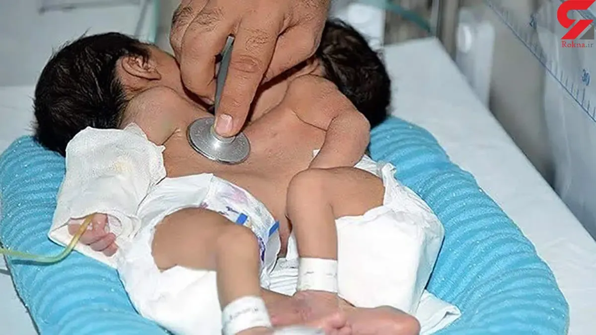 جداسازی خواهران دو قلو در بیمارستان نمازی شیراز + جزییات