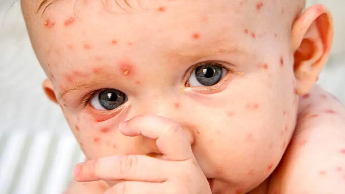 زنگ خطر شیوع سه بیماری از افغانستان به ایران