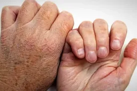 جذام سه تا پنج سال بعد از ورود باکتری نمایان می شود