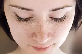 کمبود کدام ویتامین باعث لک صورت می‌شود؟