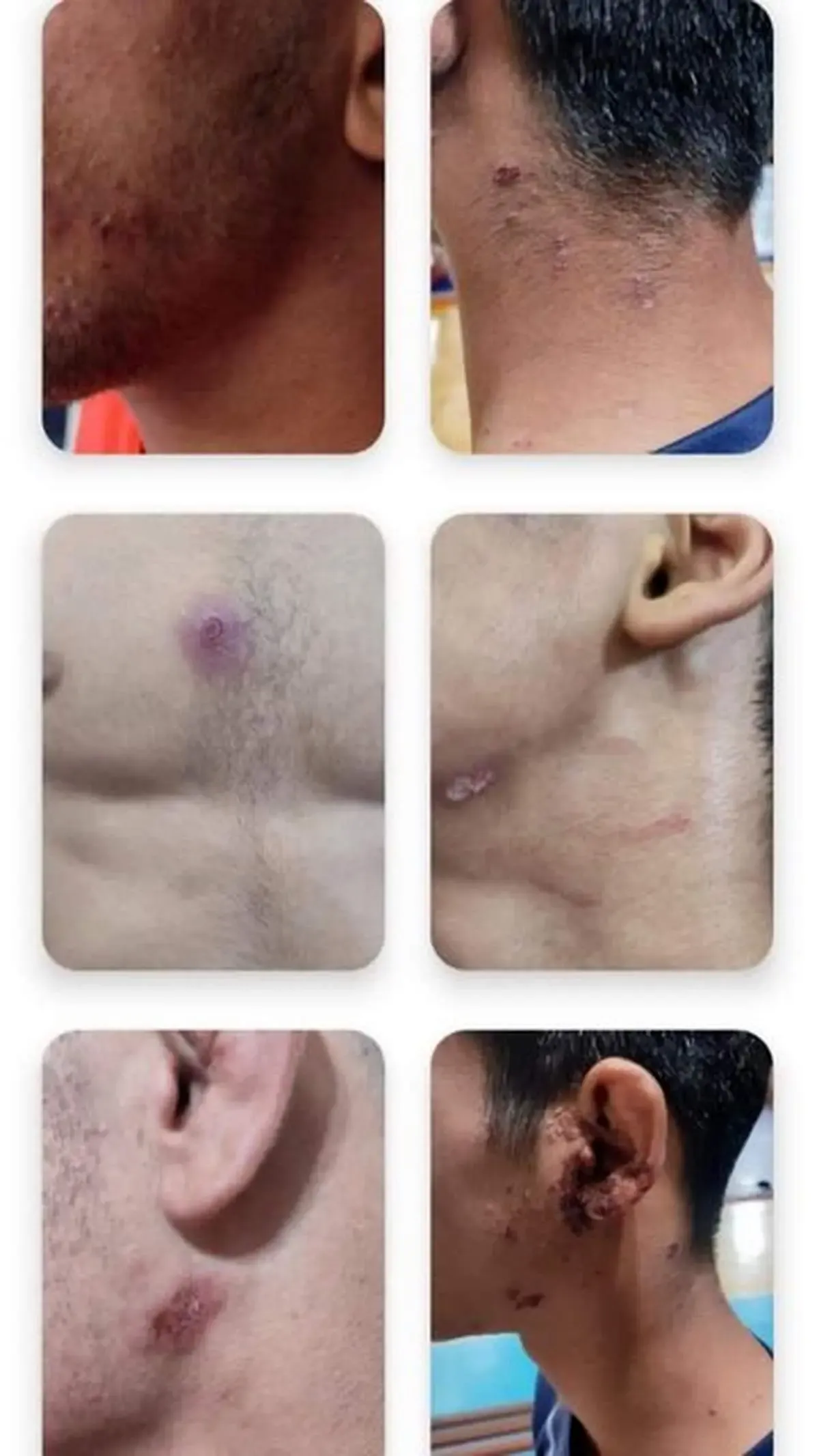 ابتلای کشتی‌گیران اندیمشکی به بیماری پوستی/ تصاویر