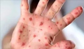 جزئیات شیوع یک بیماری کشنده در یزد