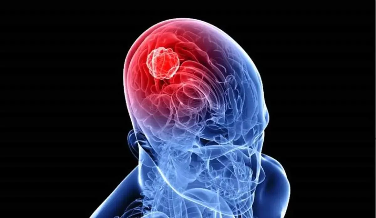 انواع تومورهای مغزی و درمان آنها