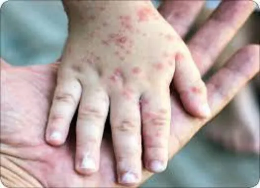 شیوع فصلی آبله‌مرغان/ شروع از زمستان تا اوج در بهار