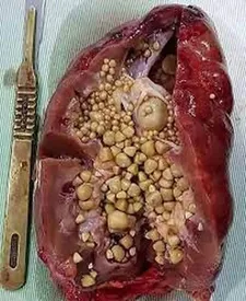 اگر این علائم را دارید کلیه تان سنگ ساز است